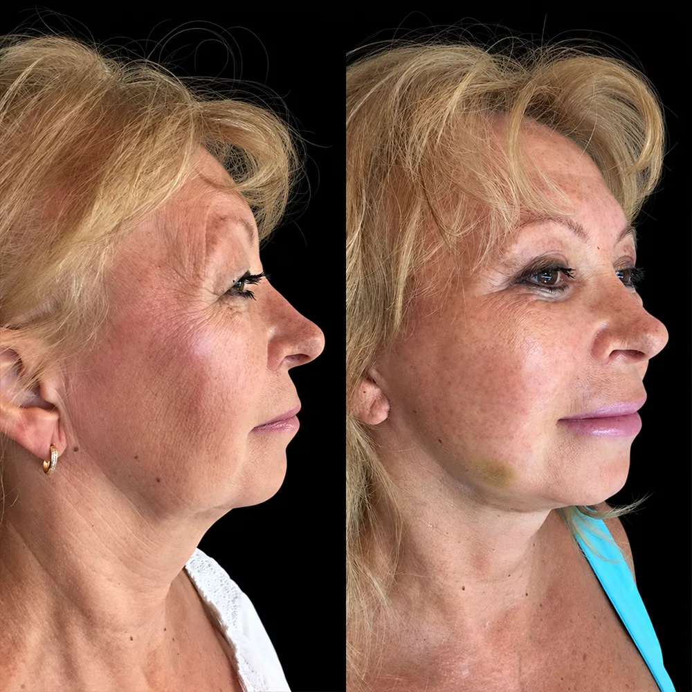 Face and neck lift, before and after, case 05, oblique view