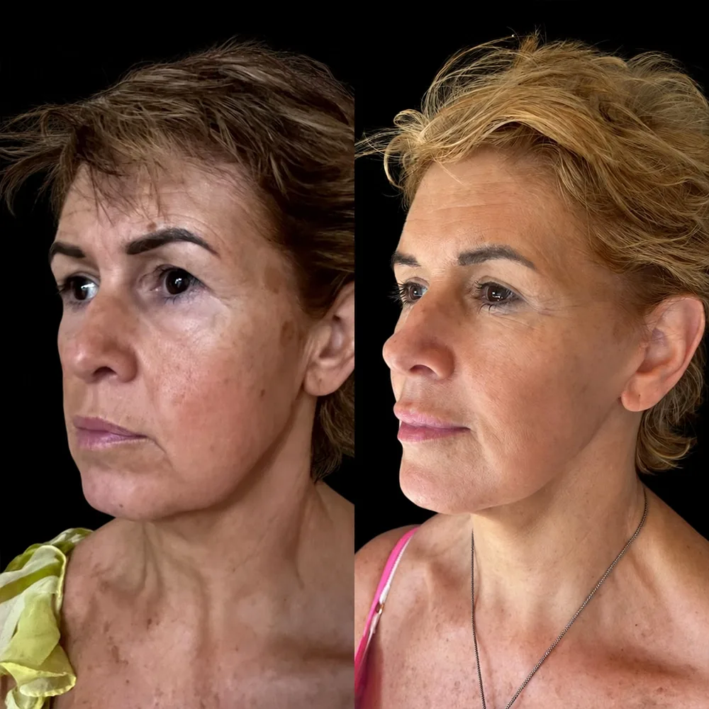 Face and neck lift, before and after, case 09, side view