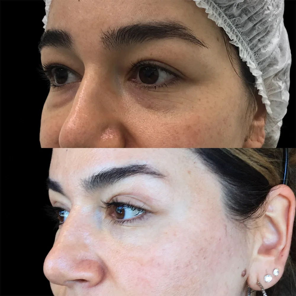 Eyelid surgery, before and after, case 08, oblique view