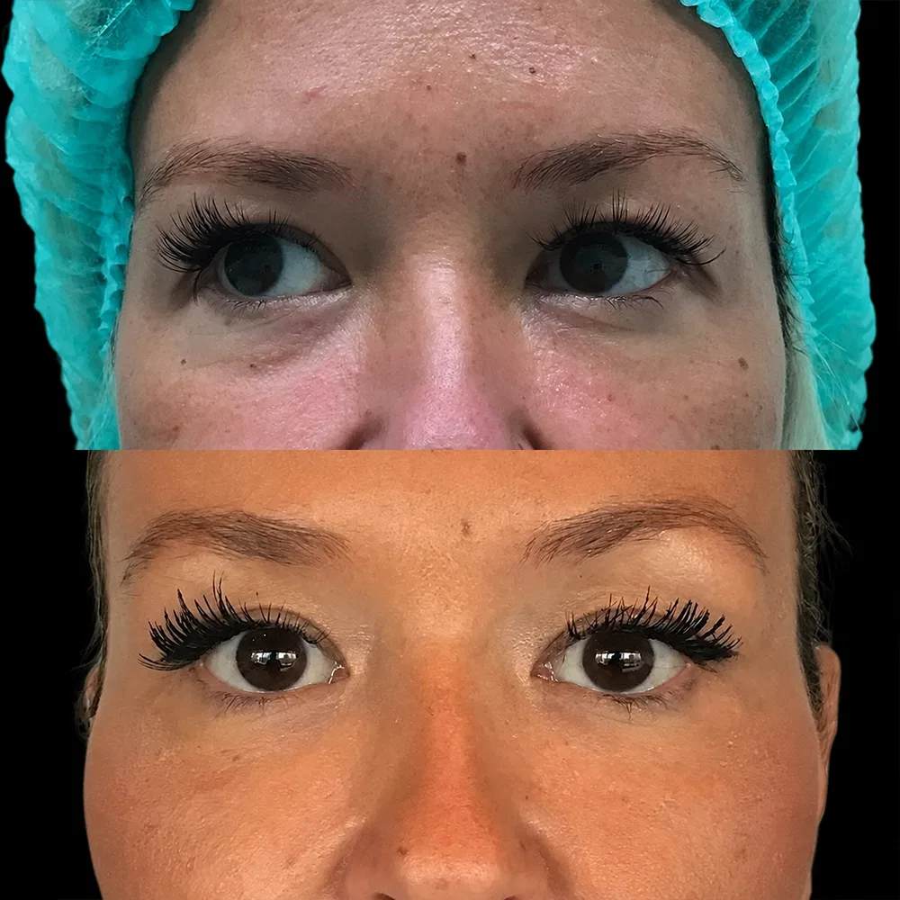 Eyelid surgery, before and after