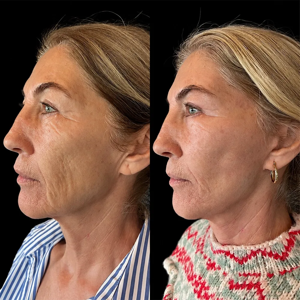 Face and neck lift, before and after, case 13, side view