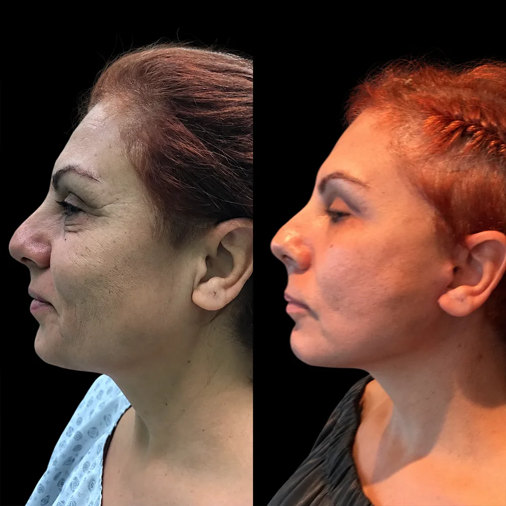 Face and neck lift, before and after, case 04, side view