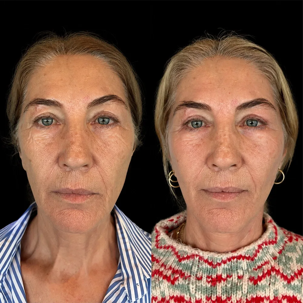 Face and neck lift, before and after, case 13, front view