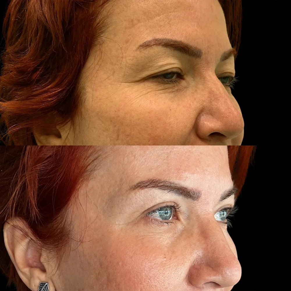 Eyelid surgery, before and after