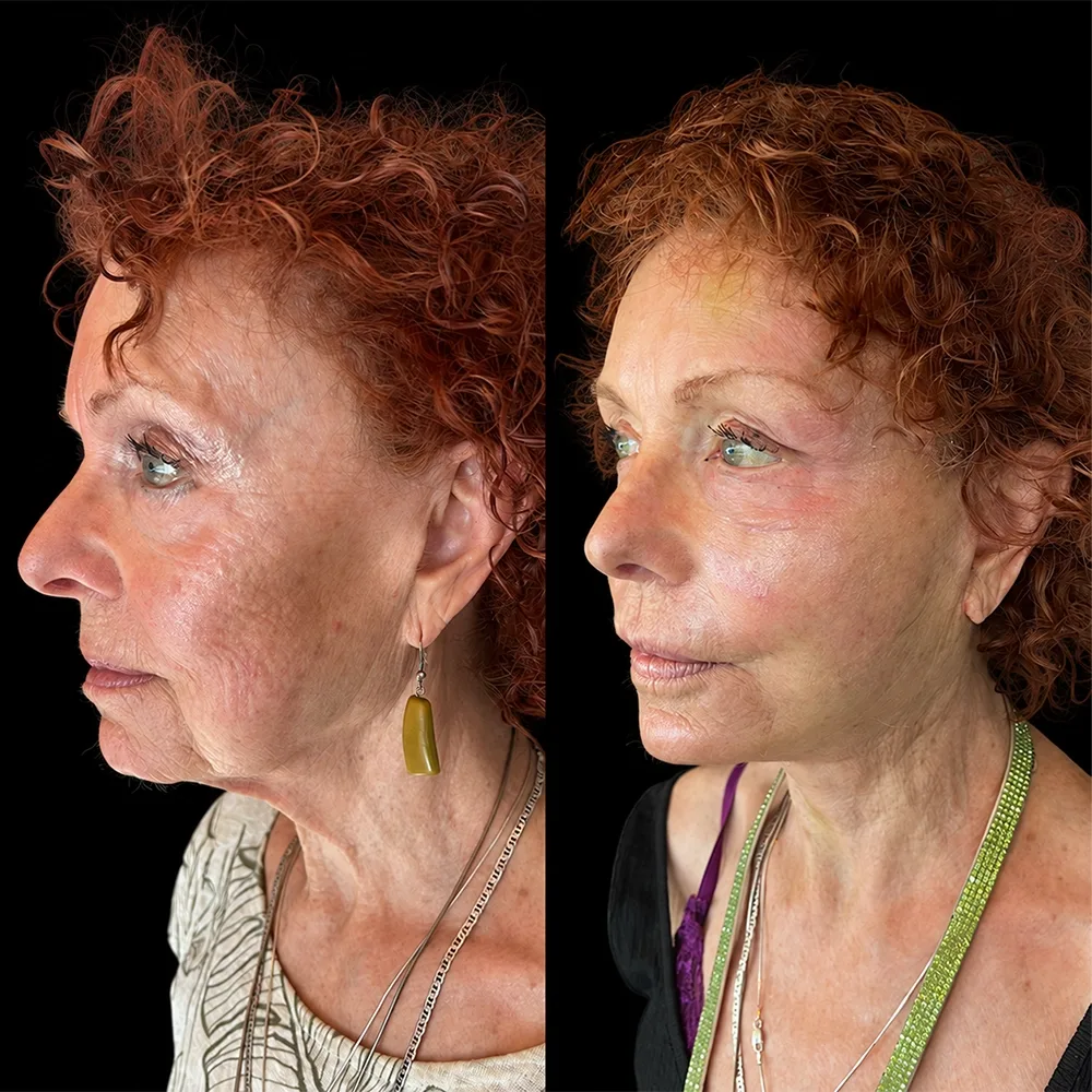 Face and neck lift, before and after, case 14, side view