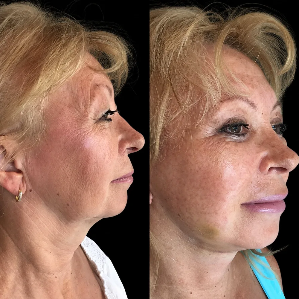 Face and neck lift, before and after