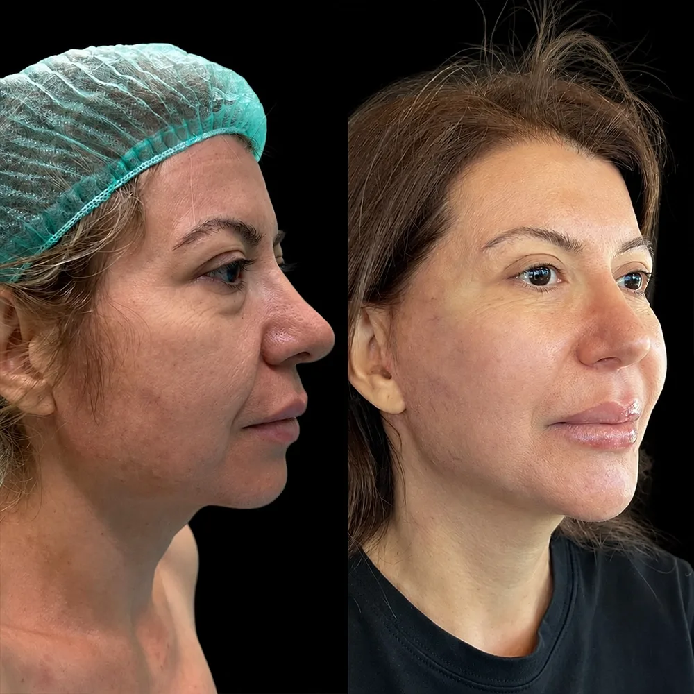 Face and neck lift, before and after, case 12, side view