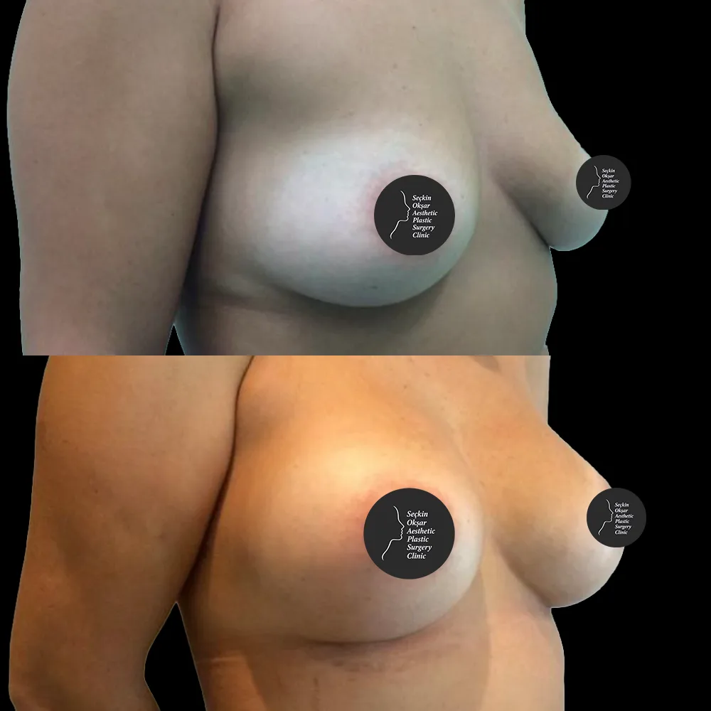 Breast augmentation, before and after, case 11, front view