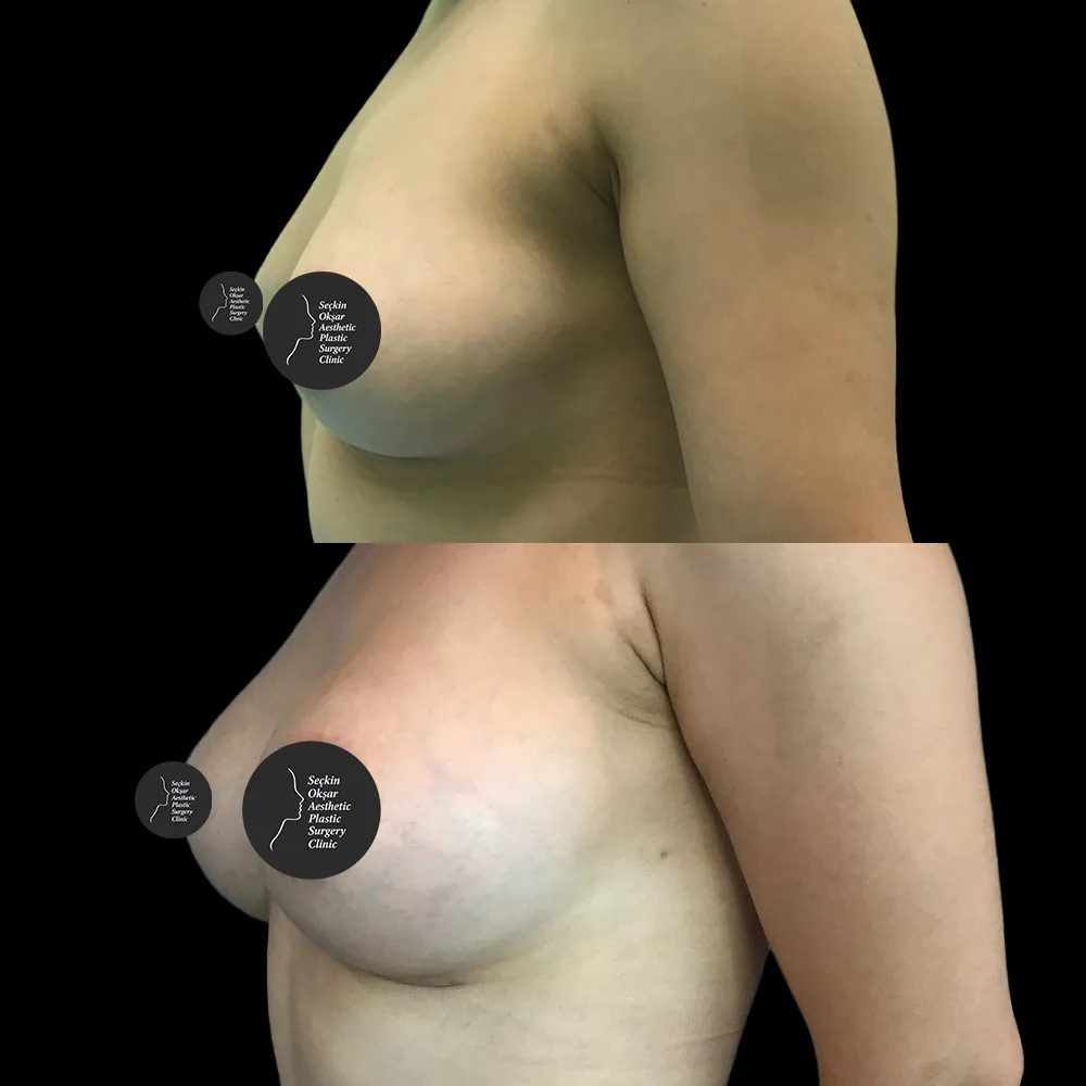 Breast augmentation, before and after, case 07, oblique view