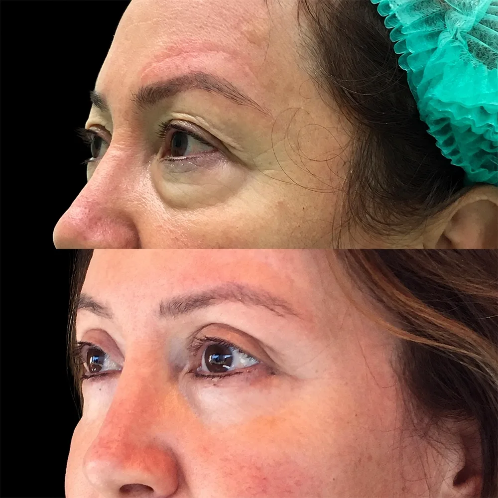 Eyelid surgery, before and after, case 03, oblique view