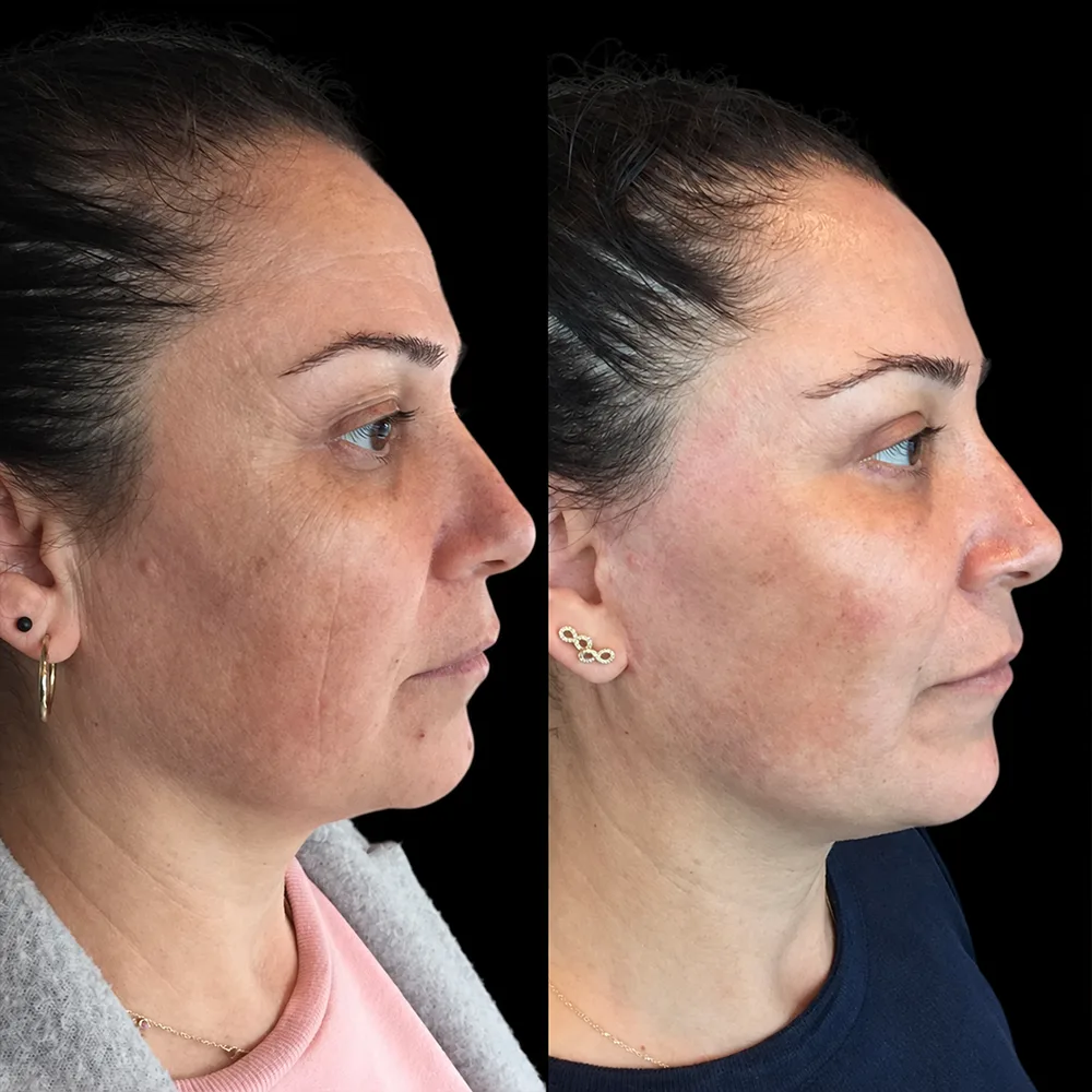 Face and neck lift, before and after