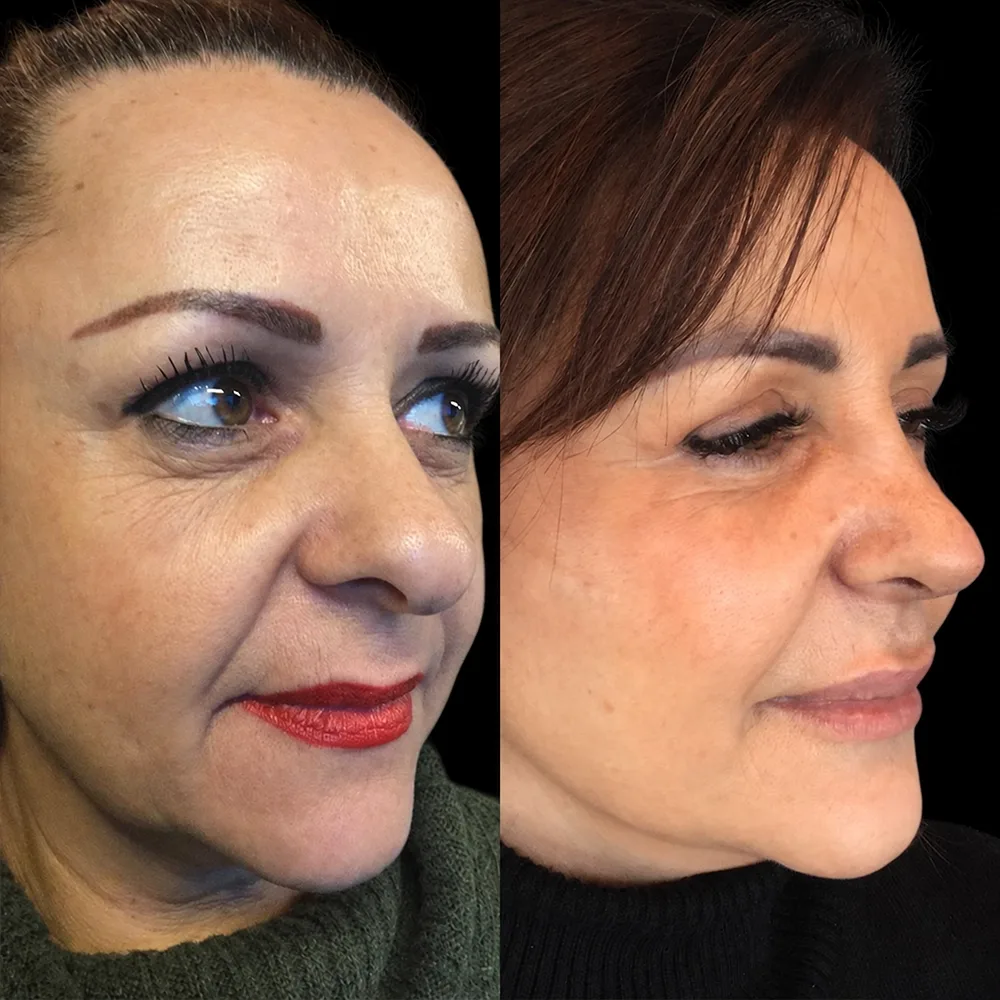 Face and neck lift, before and after