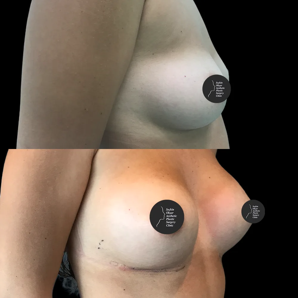 Breast augmentation, before and after, case 06, front view