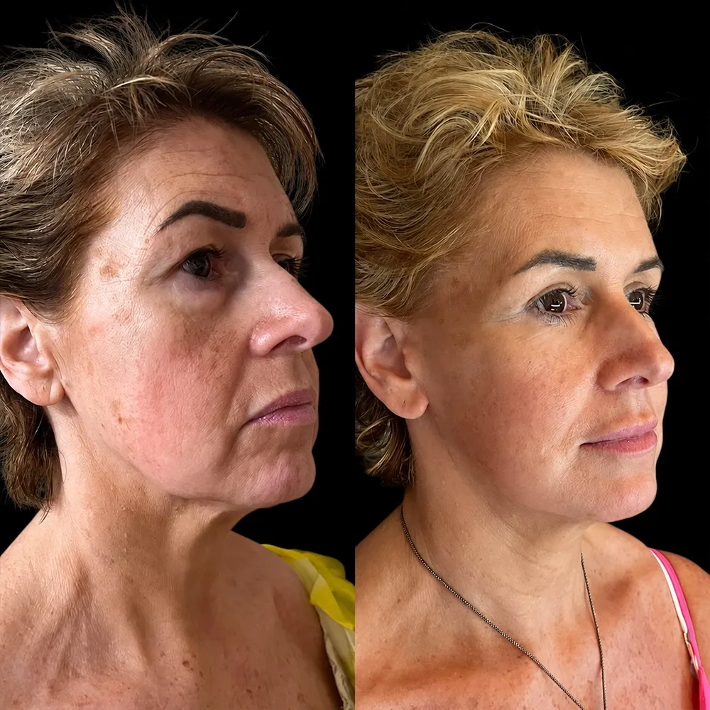 Face and neck lift, before and after, case 09, oblique view
