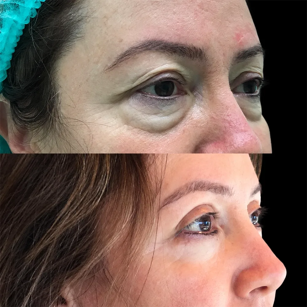 Eyelid surgery, before and after, case 03, side view