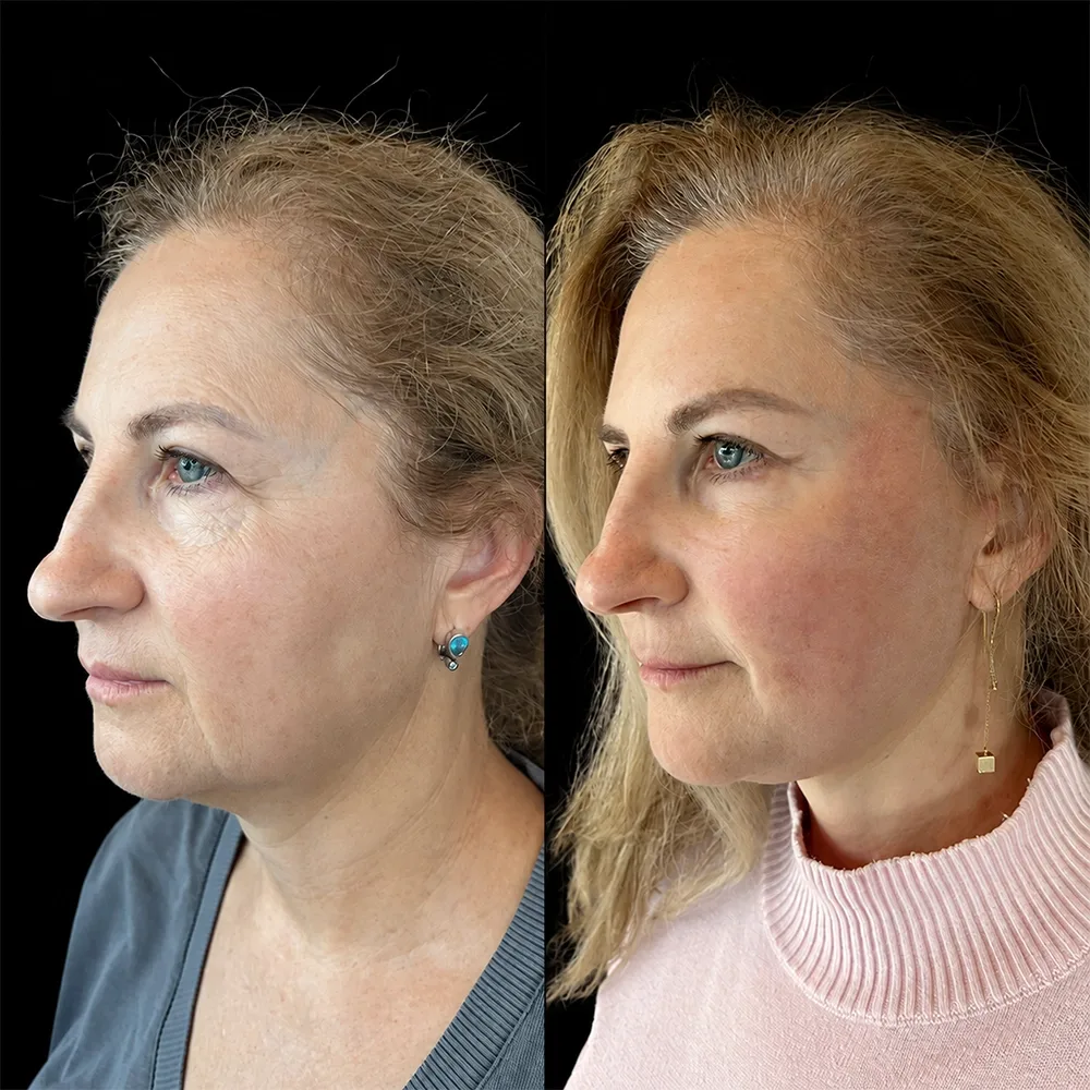 Face and neck lift, before and after, case 17, oblique view