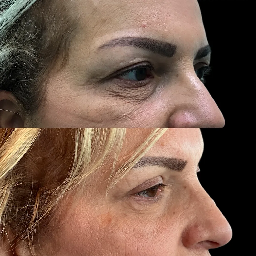 Eyelid surgery, before and after, case 10, side view