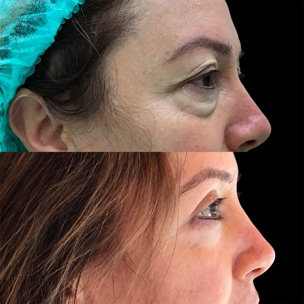 Eyelid surgery, before and after, case 03, profile view