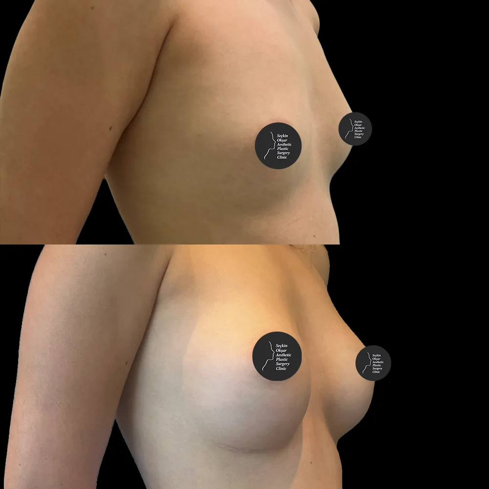 Breast surgery, before and after