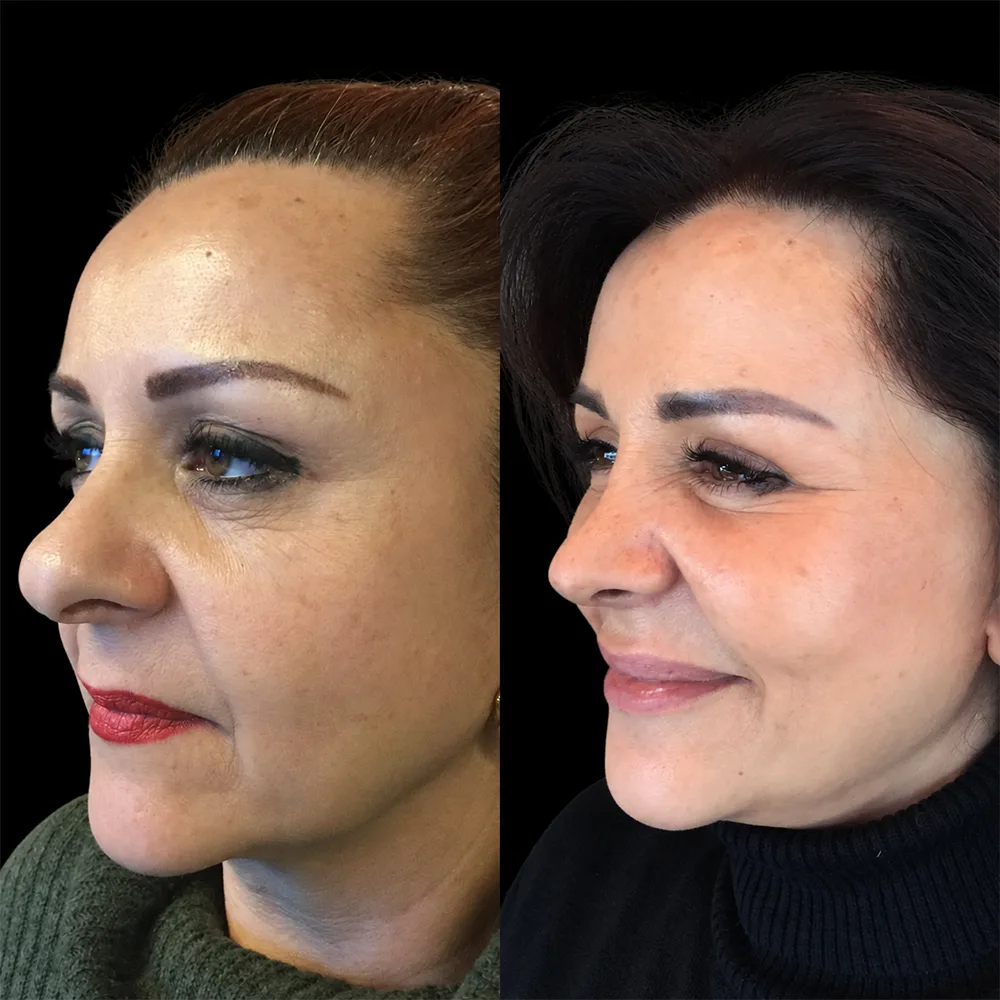 Face and neck lift, before and after, case 03, side view