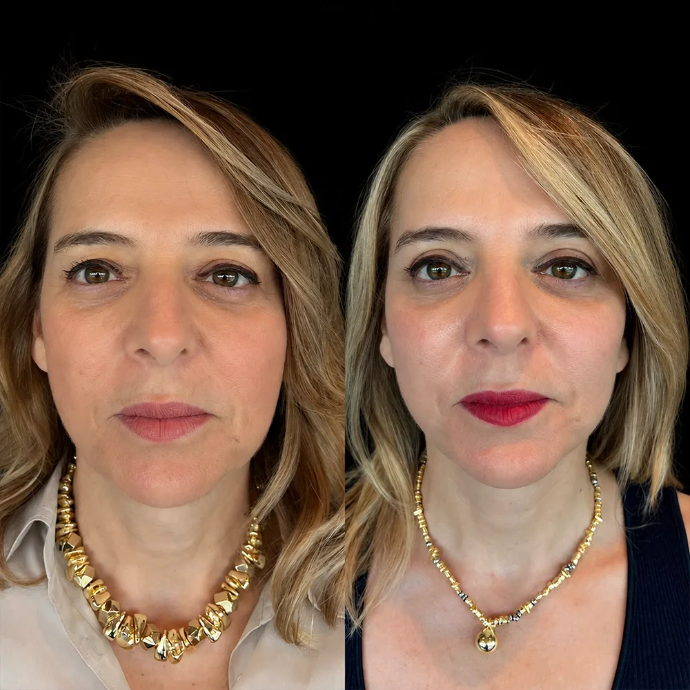 Face and neck lift, before and after, case 15, front view