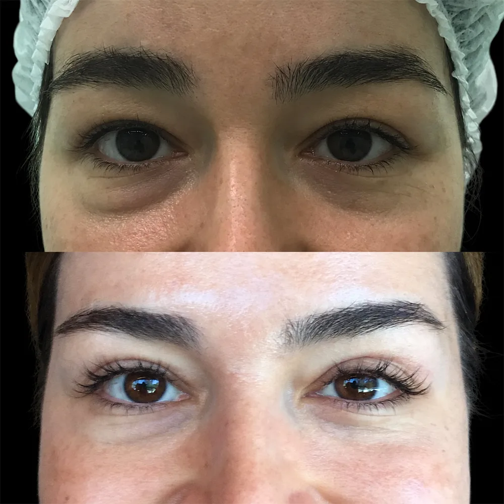 Eyelid surgery, before and after