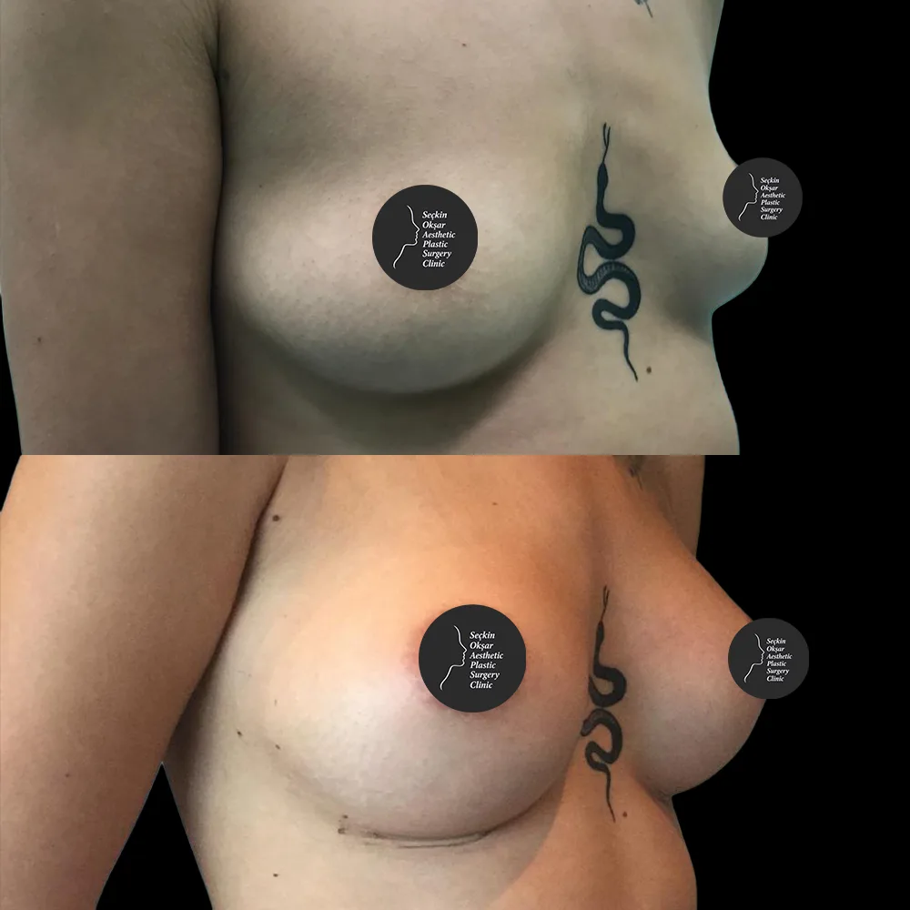Breast augmentation, before and after