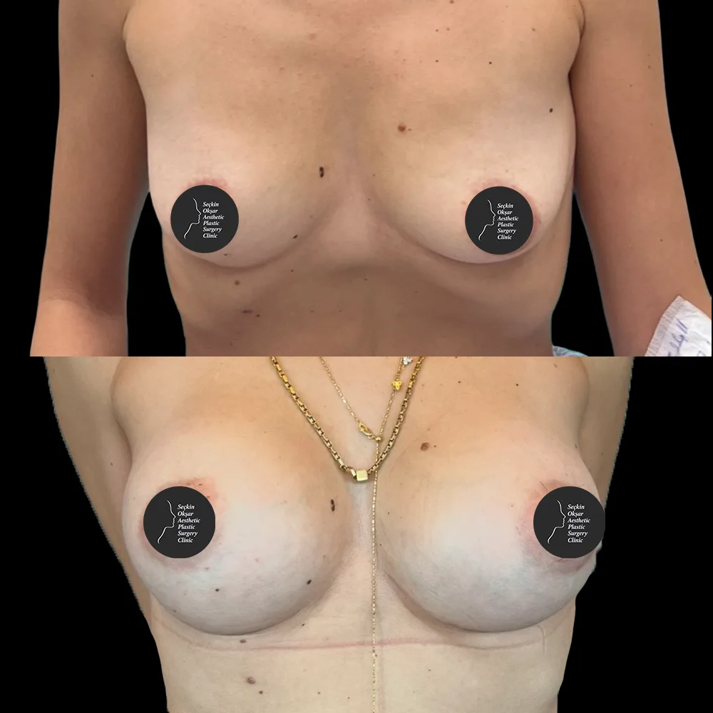 Breast augmentation, before and after