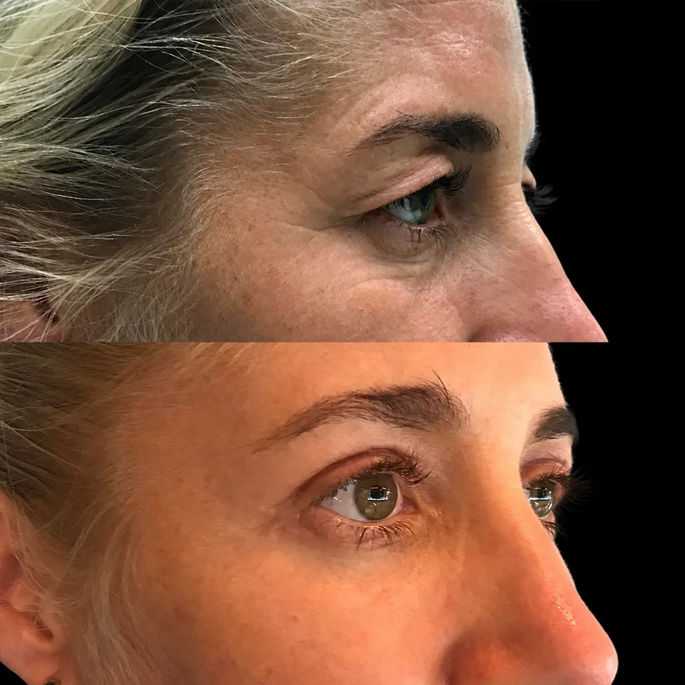 Eyelid surgery, before and after, case 01, side view