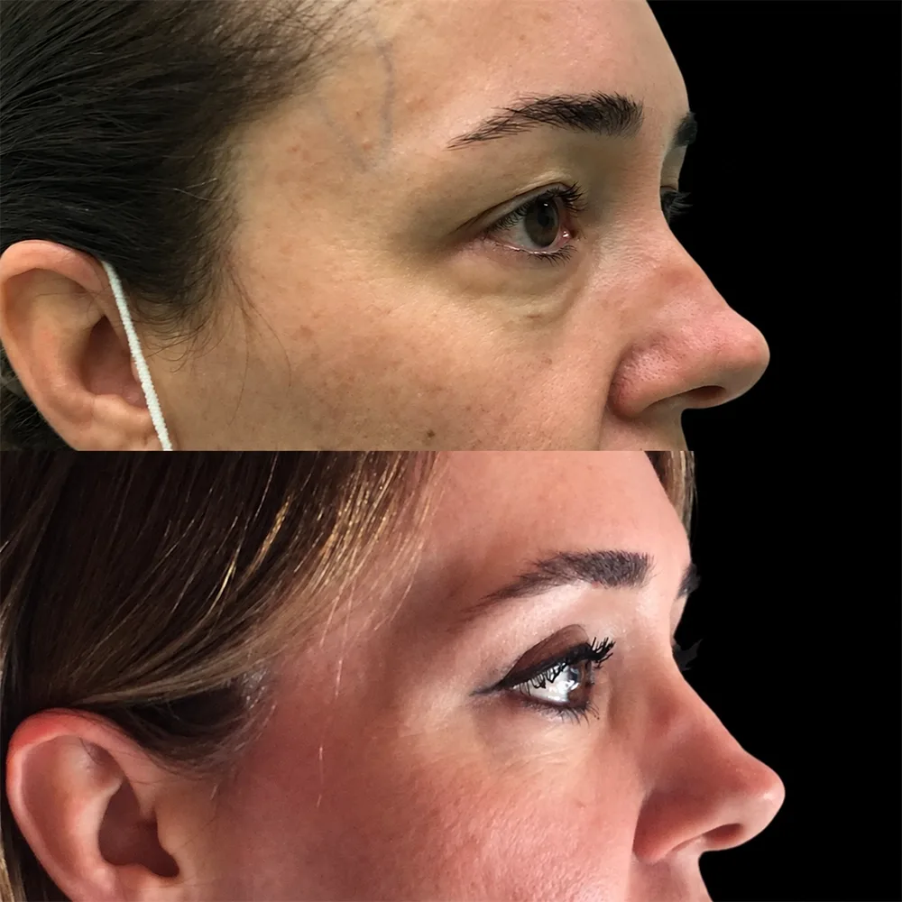 Eyelid surgery, before and after, case 06, oblique view