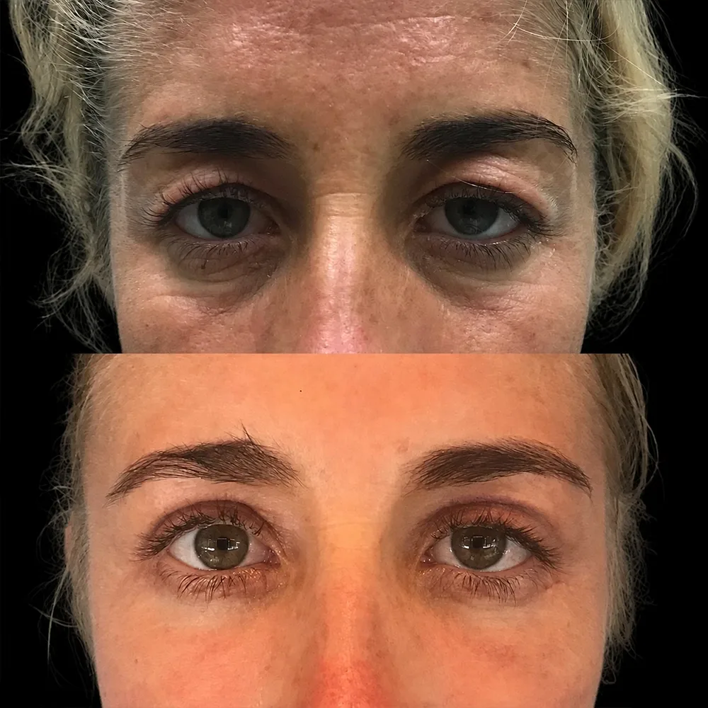 Eyelid surgery, before and after, case 01, front view