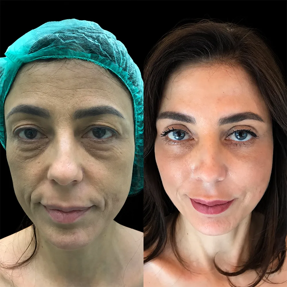 Face and neck lift, before and after