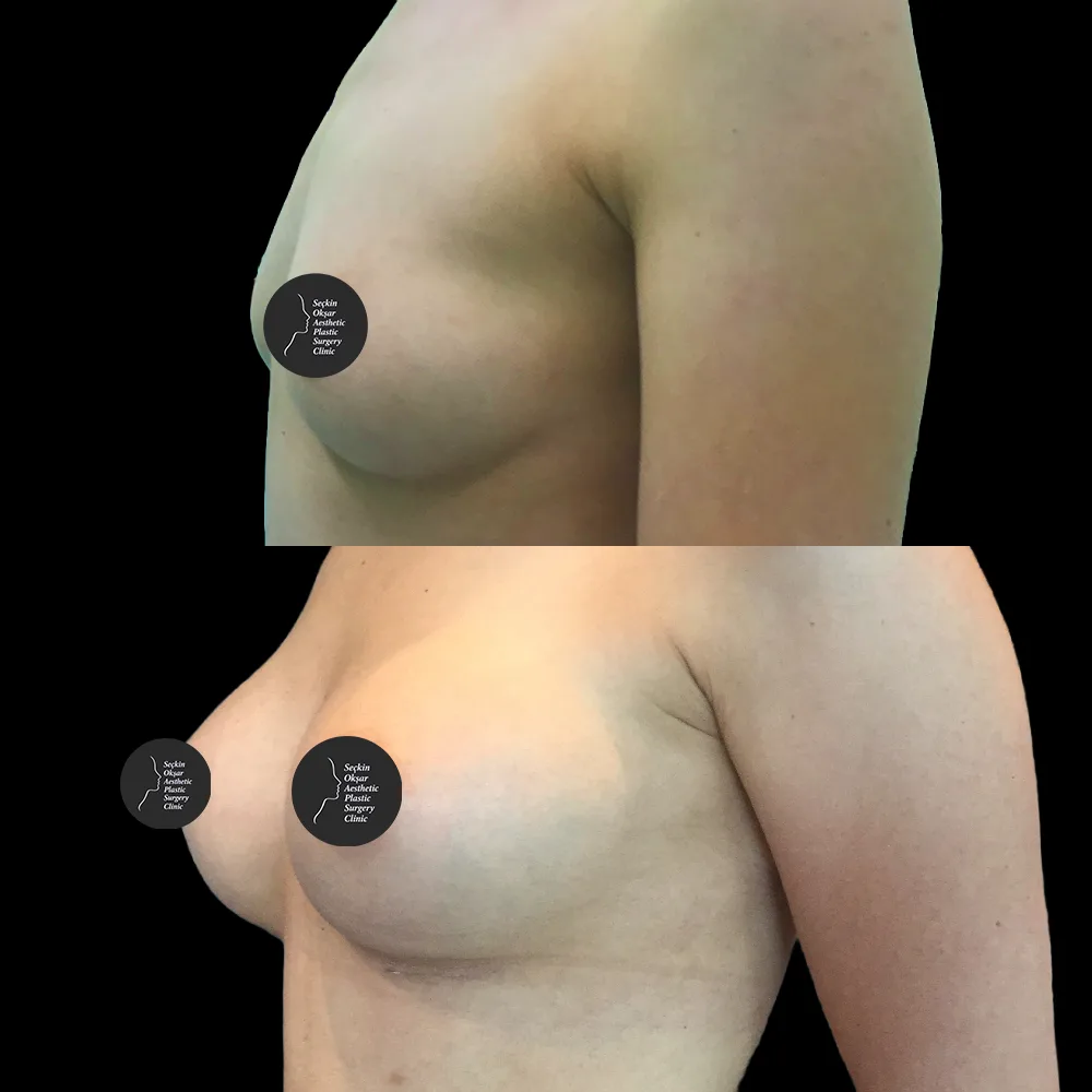 Breast augmentation, before and after, case 02, oblique view