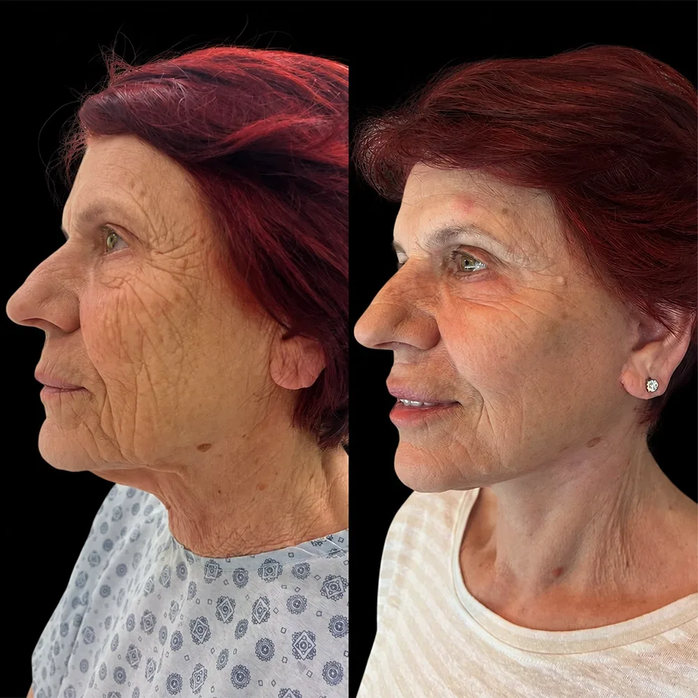 Face and neck lift, before and after, case 11, side view
