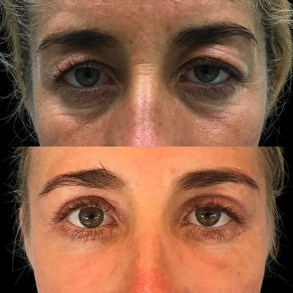 Eyelid surgery, before and after