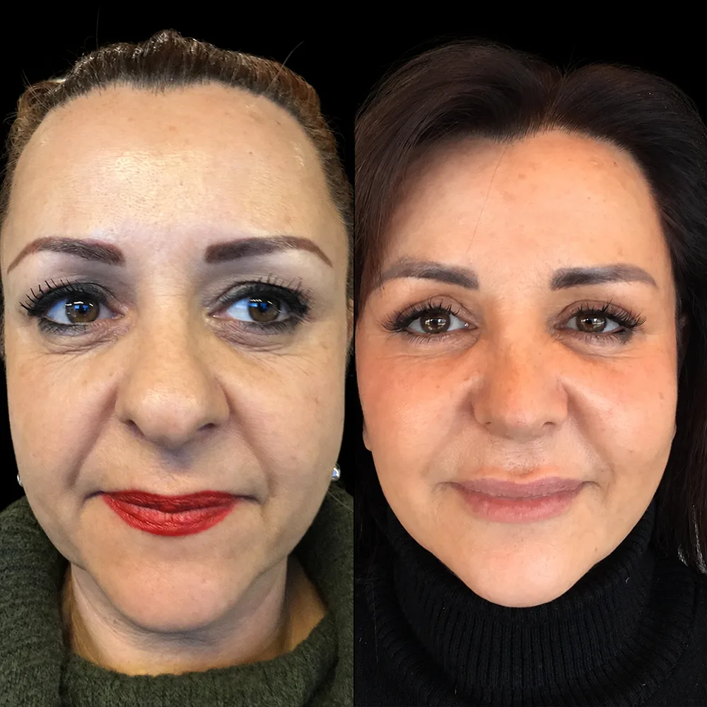 Face and neck lift, before and after, case 03, front view