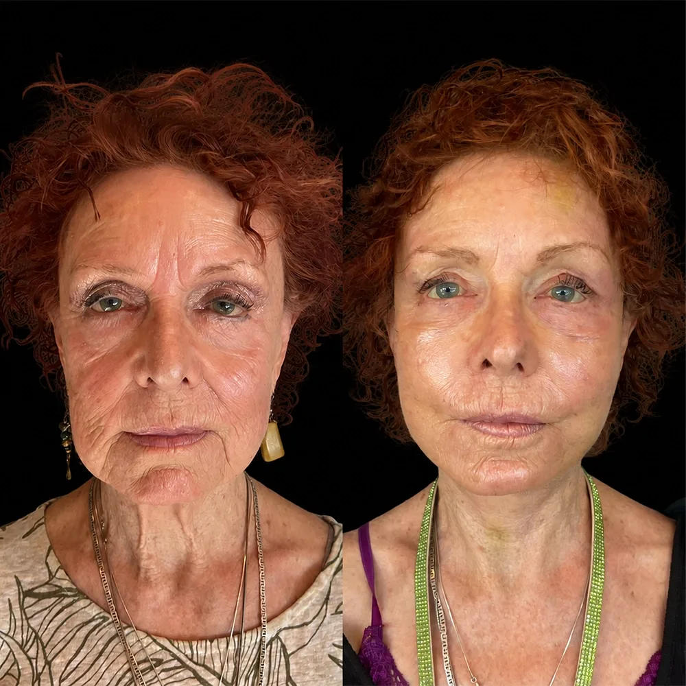 Face and neck lift, before and after, case 14, front view