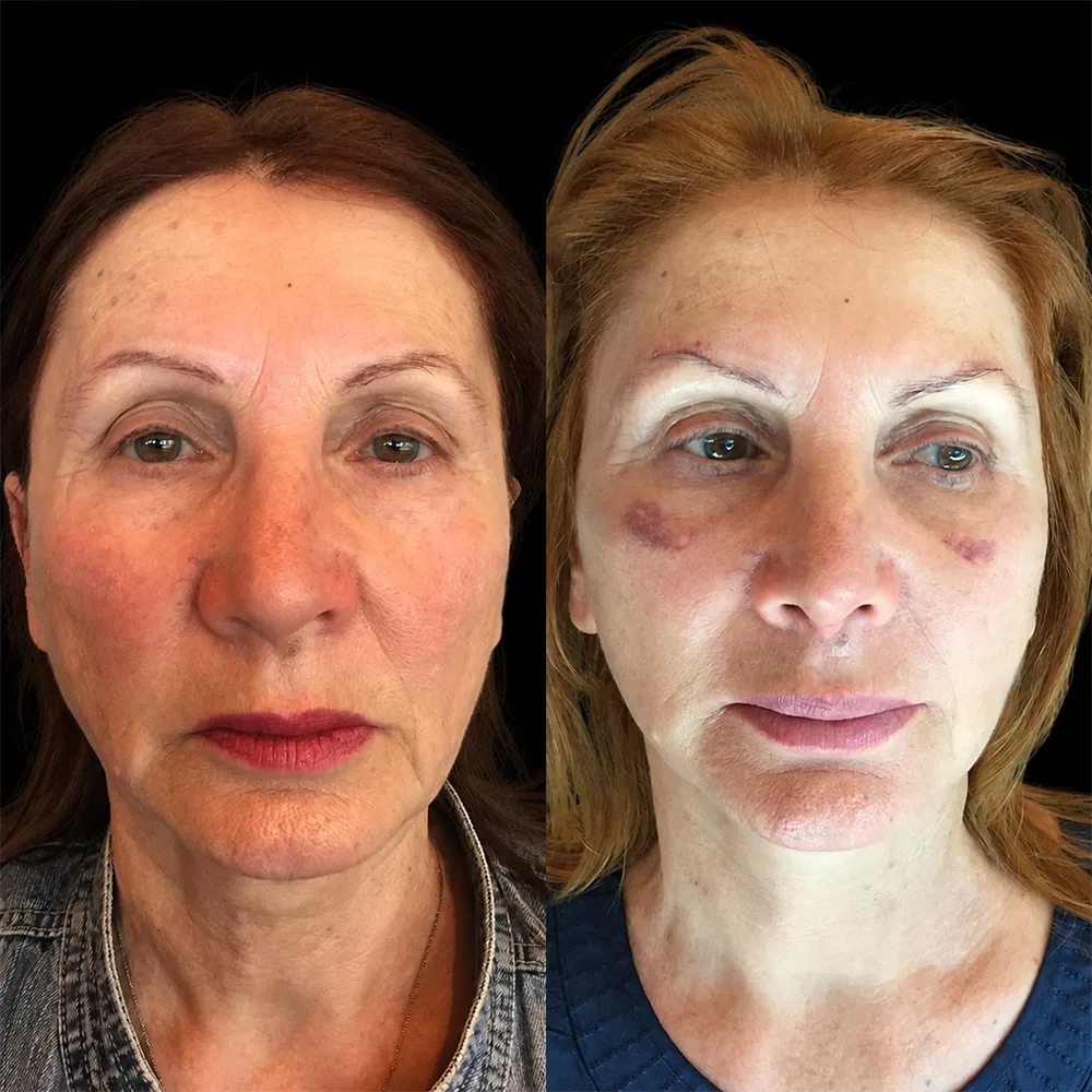 Face and neck lift, before and after, case 06, front view