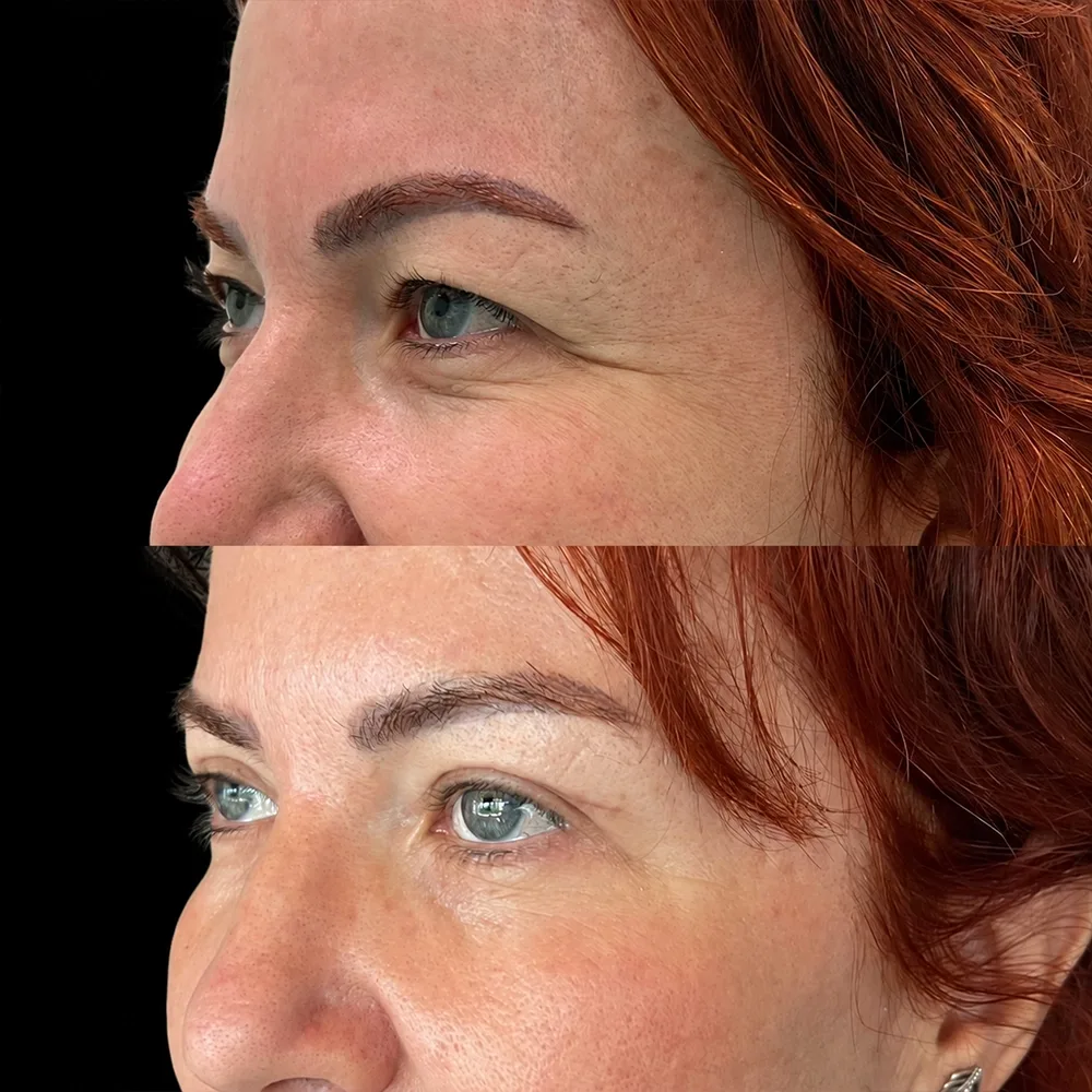 Eyelid surgery, before and after, case 04, oblique view
