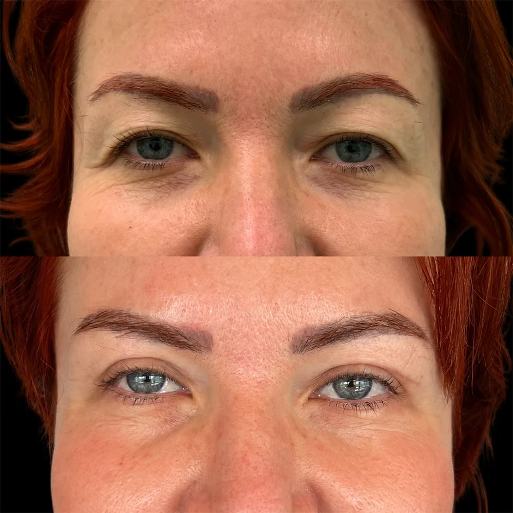 Eyelid surgery, before and after, case 04, front view