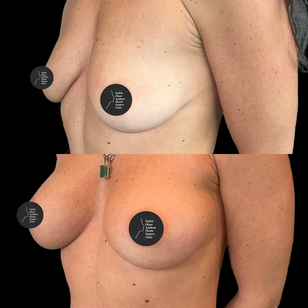 Breast augmentation, before and after, case 10, front view