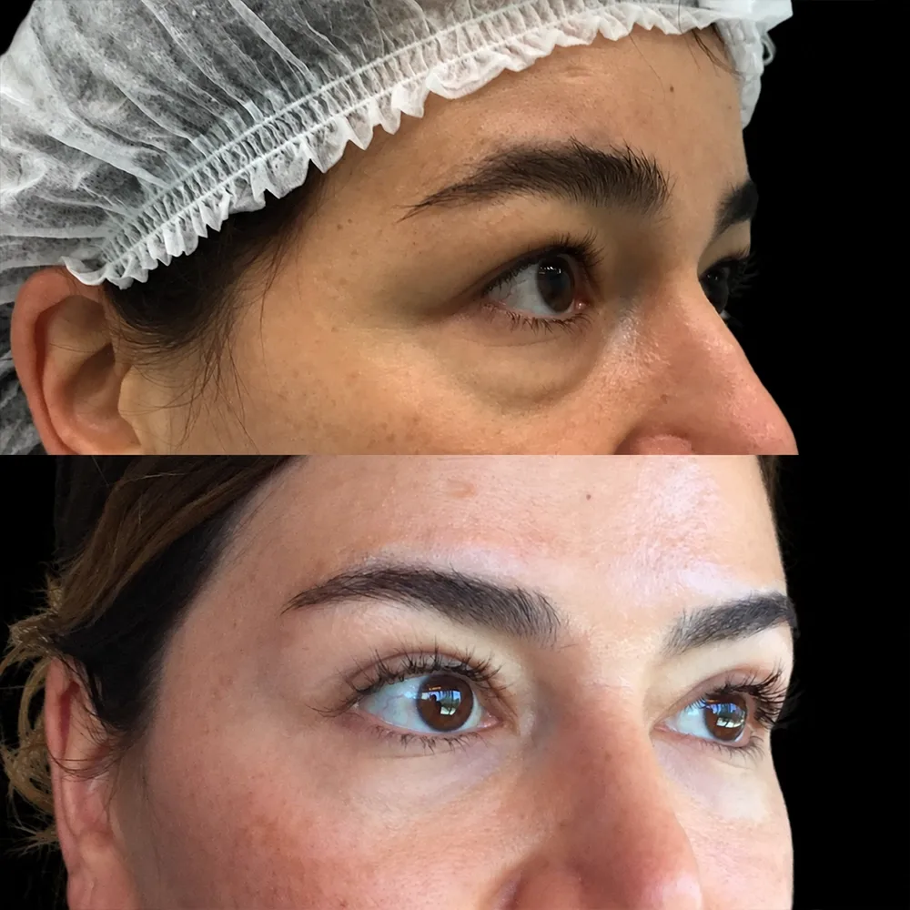 Eyelid surgery, before and after, case 08, side view