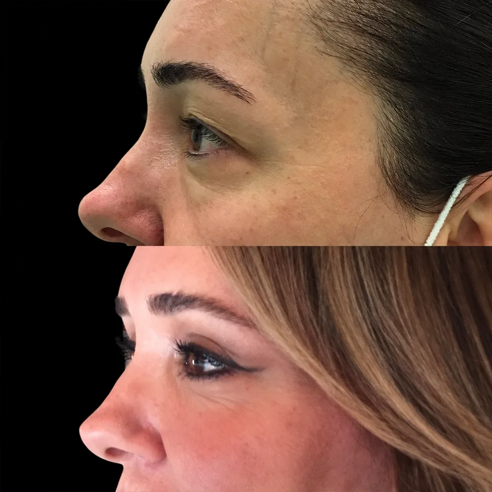 Eyelid surgery, before and after, case 06, profile view