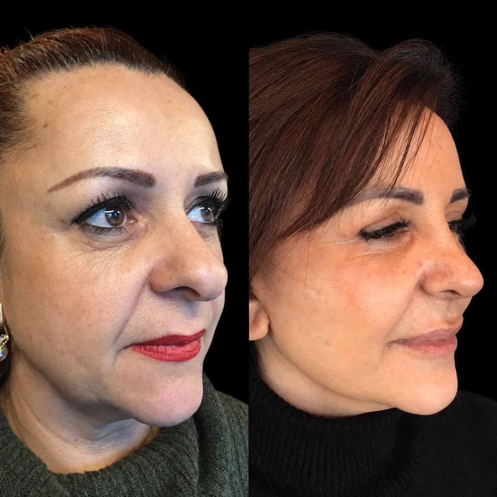 Face and neck lift, before and after, case 03, oblique view