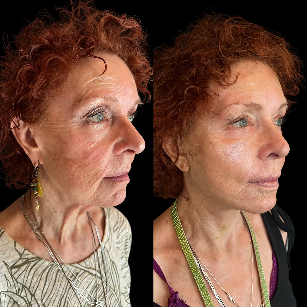 Face and neck lift, before and after, case 14, oblique view
