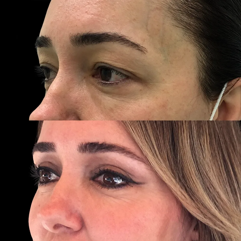 Eyelid surgery, before and after, case 06, side view