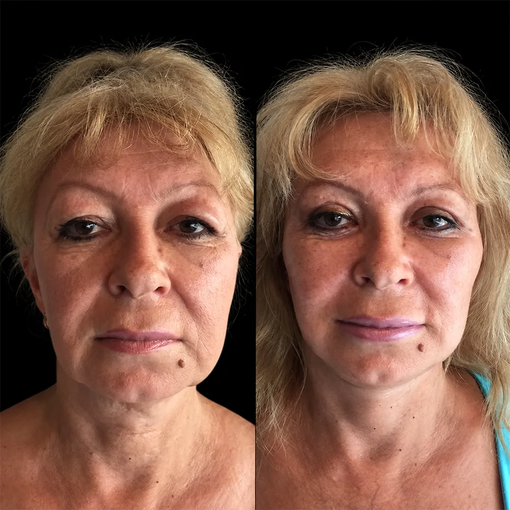 Face and neck lift, before and after, case 05, front view