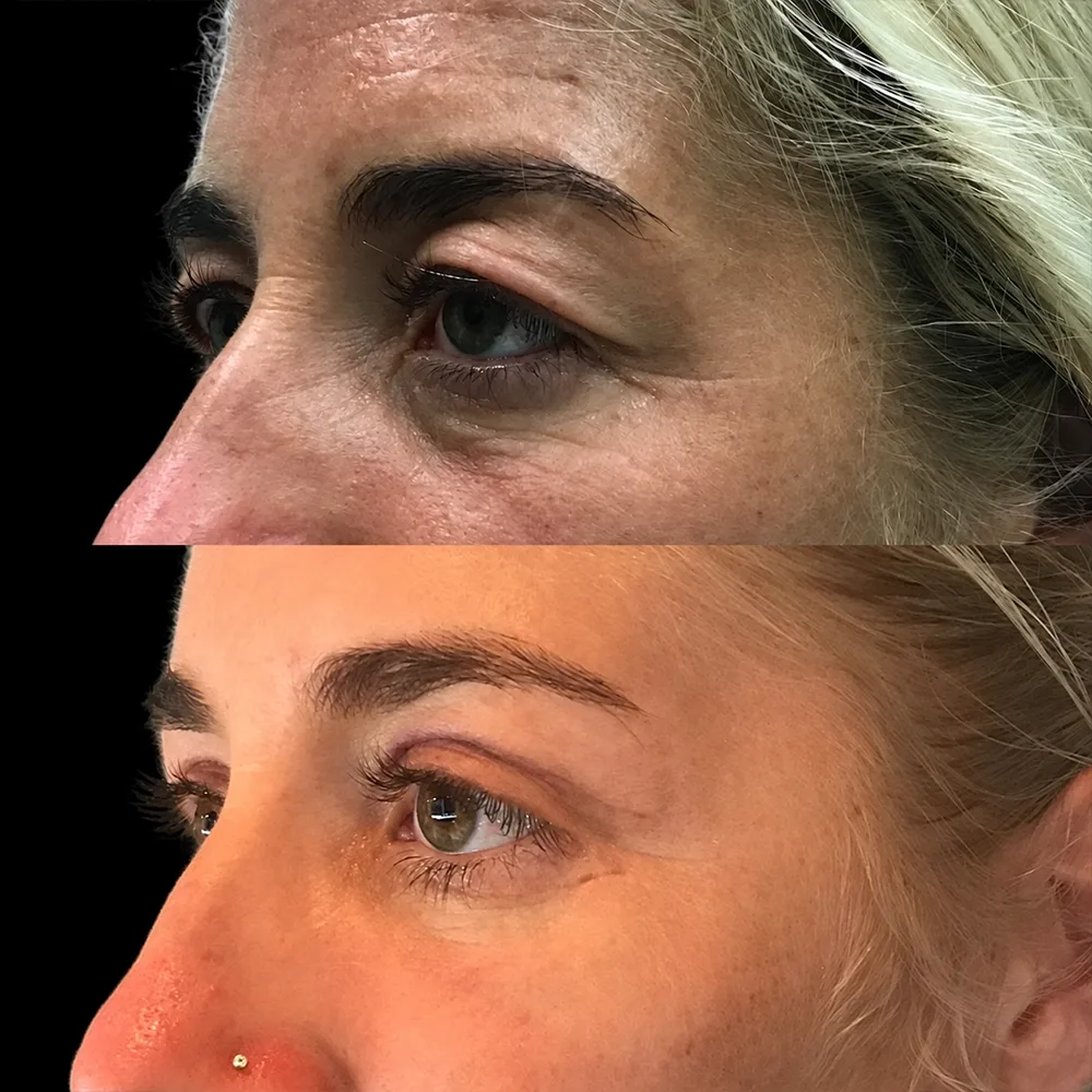 Eyelid surgery, before and after, case 01, oblique view