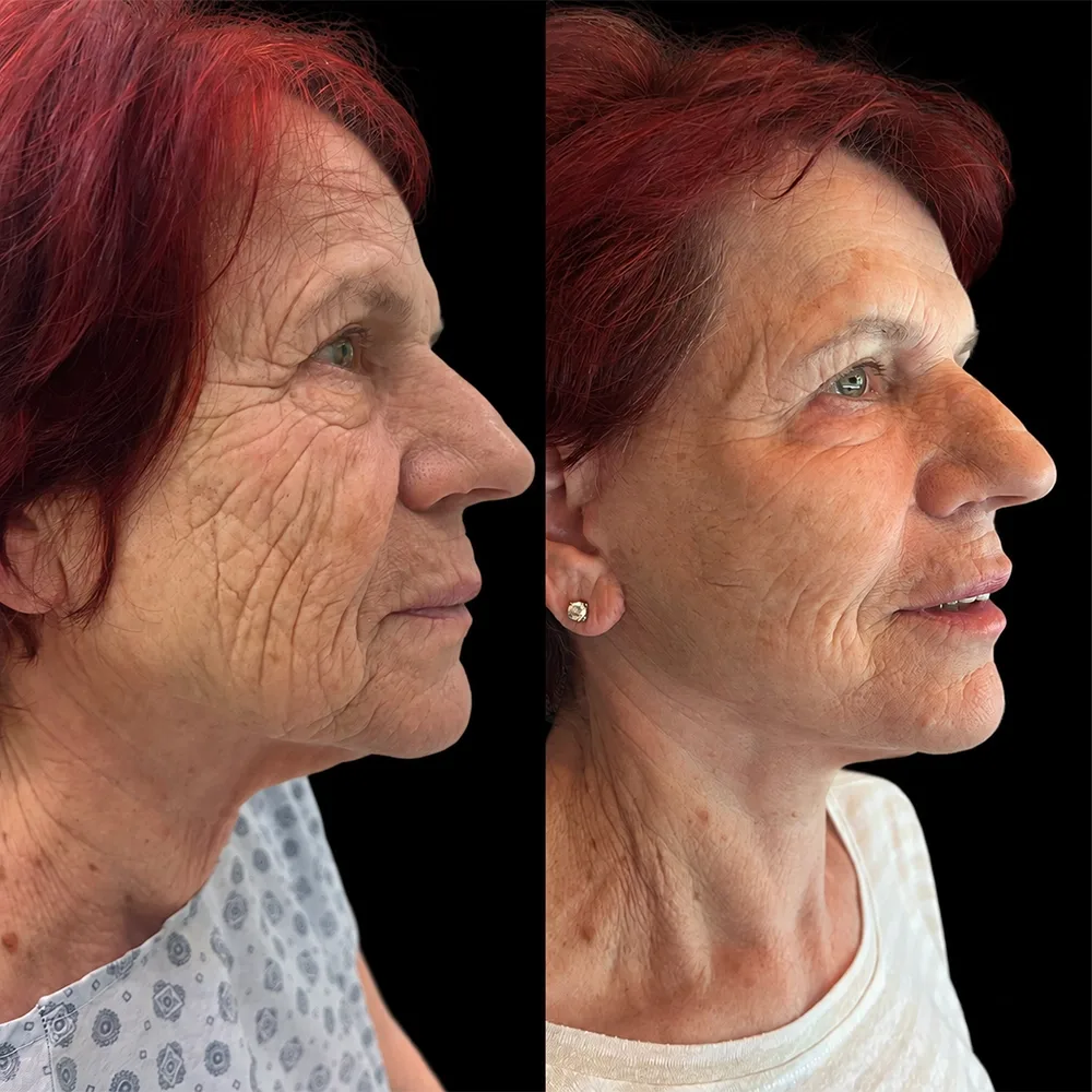 Face and neck lift, before and after, case 11, oblique view