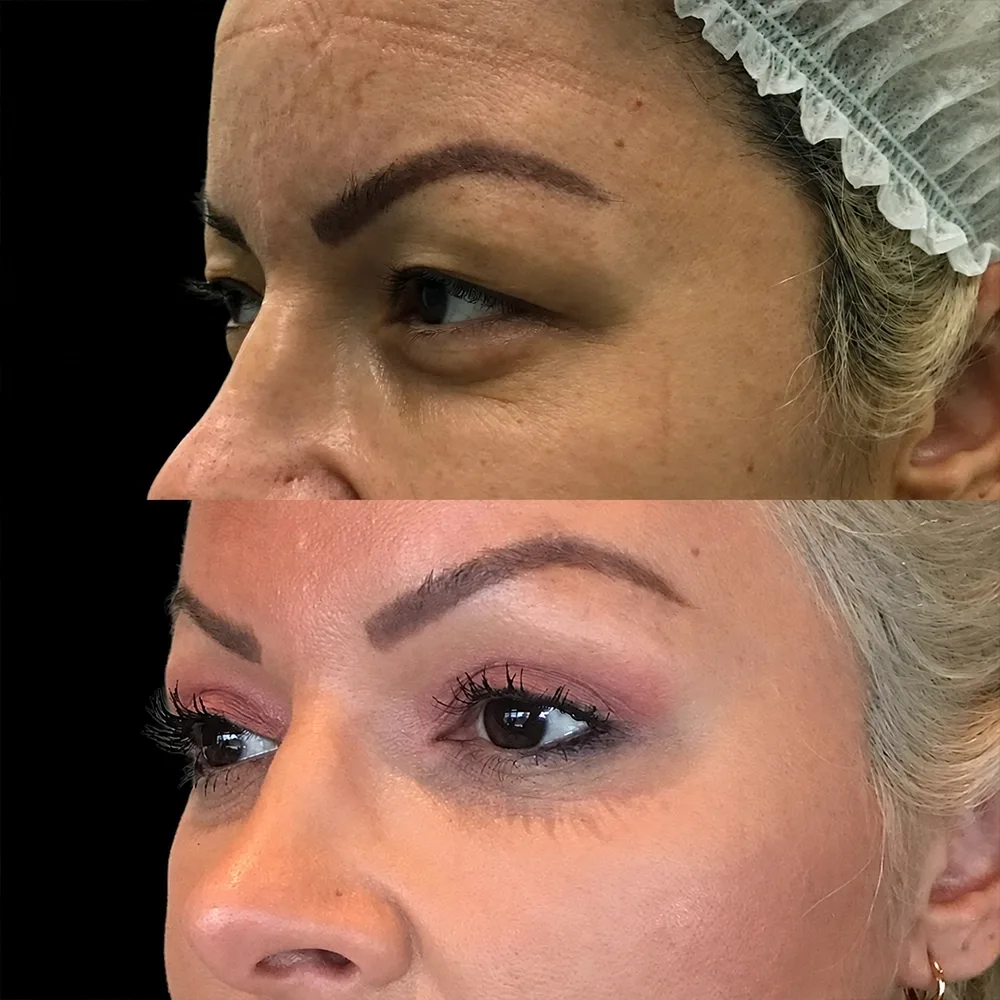 Eyelid surgery, before and after, case 02, side view